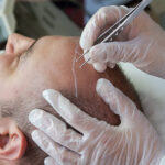 Hair Transplant Cost in Saudi Arabia 2026